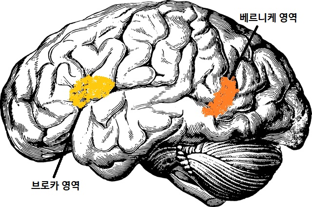 실어증 부위 1